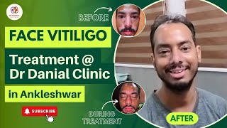 Dr Danials Face Vitiligo Treatment  Amazing Before amp After Results of Mohan  vitiligotreatment [upl. by Ocicnarf]