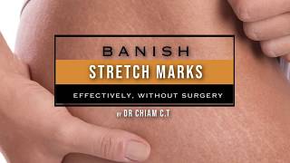 Stretch Marks How They Appear amp Options To Reduce Their Appearance [upl. by Felicie339]