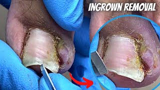 Remove this Long Infected ingrown toenail pain  Podiatrist Pedicure treatment amp How to cut cure [upl. by Castor]