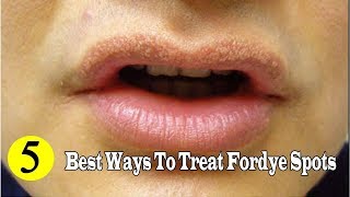 5 Best Ways to Remove Fordyce Spots Naturally at Home YouTube [upl. by Hendel]