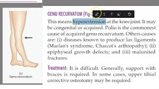 Orthopedics 344 genu recurvatum Polio hyperextension of knee joint [upl. by Anreval358]