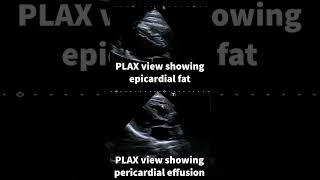 Epicardial fat [upl. by Apicella]