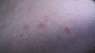 Shingles Rash Early Stages [upl. by Llerraf]