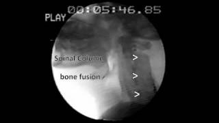 Zenkers diverticulum Barium Swallow [upl. by Illib]