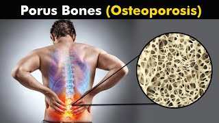 What happens in Osteoporosis  animation [upl. by Suiratnod331]