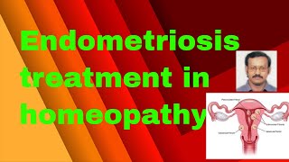 Endometriosis treatment in homeopathy homeopathic remedies for endometriosis [upl. by Siravrat]