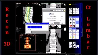 LEARN RECONSTRUCTION CT LUMBAR SCAN  Siemens 16 Slice [upl. by Larret]