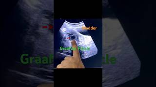 Graafian Follicle infertility pregnancyjourney bestultrasound baby ytshorts short pcod pcos [upl. by Macy511]