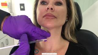 Botox for Neck Bands Platysmal Bands Dr Amir Moradi San Diego California Moradi MD [upl. by Bashemeth]