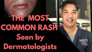 How to treat Perioral Dermatitis Dermatologist Explains [upl. by Valdes]