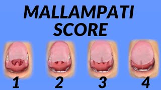 Mallampati Score Airway Assessment Technique Animation [upl. by Llet412]