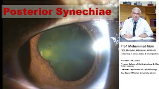 Post Synechiae in Uveitis [upl. by Eecats]