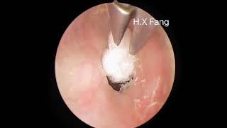 Tympanic effusion after reflex therapy for nasopharyngeal carcinoma鼻咽癌反射治疗后鼓室积液20230904 [upl. by Head]