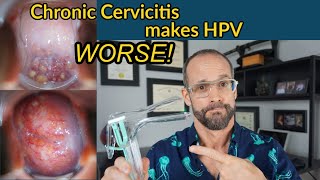 HPV combined with chronic cervicitis increases the risk of severe dysplasia and cervical cancer [upl. by Akieluz]