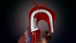 Thoracic Stent Animation [upl. by Yenatirb]