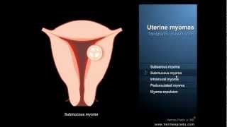 Uterine fibroids or myomas  Definition and symptoms [upl. by Spenser]