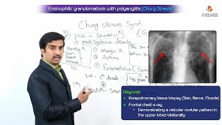 Eosinophilic granulomatosis with polyangiitis  ChurgStrauss Syndrome [upl. by Cinda936]