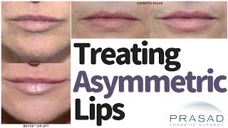 How to Treat Asymmetric Lips and Smiles [upl. by Zsuedat]