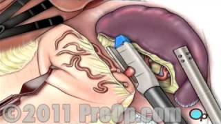 Spleen Removal Surgery Laparoscopic Splenectomy PreOp® Patient Education [upl. by Anyahs319]