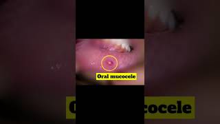 Mucocele awareness Dentist [upl. by Oinotna]