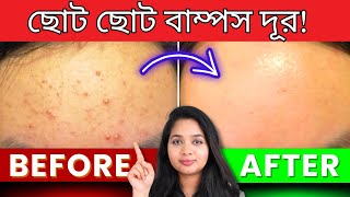 🟢 ফাংগাল একনি থেকে মুক্তির উপায়  Fungal Acne amp Small Bumps Treatment [upl. by Loni]