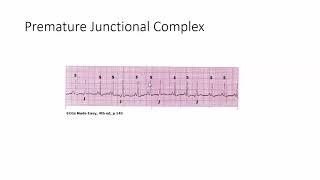 Premature Junctional Complex [upl. by Heida]