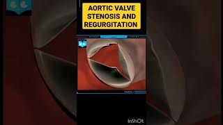 Aortic Valve Stenosis And Regurgitation  Animation  shorts Biology [upl. by Neerahs]