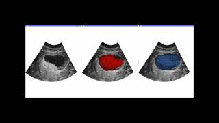 Automated ultrasound segmentation technique for placental volume determination [upl. by Georgena]