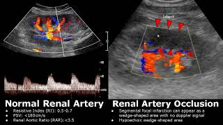 Renal Artery Doppler Ultrasound Normal Vs Abnormal Images  StenosisOcclusionAVM  Kidney USG [upl. by Niletac]