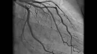 Coronary Angiography  NEJM [upl. by Belanger]