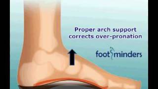 Foot Pain Due to Flat Feet and OverPronation An Easy Solution [upl. by Asiluj]