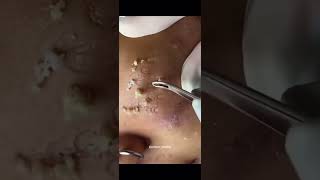 Blackheads Removal  Acne Treatment and Very Satisfying Satisfying Pimple pop blackheads [upl. by Wehtta]