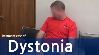 Cervical Dystonia  Dystonia  Spasmodic Torticollis  사경증 치료사례  근긴장이상증 [upl. by Eilyr]