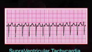 Introduction to EKG Rhythm Interpretation Part 3 [upl. by Cynthla229]