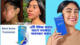 রাতারাতি ব্রন দূর করার জেল কতটা কার্যকরী Differin Gel Acne Treatment  khadija begum [upl. by Kachine732]