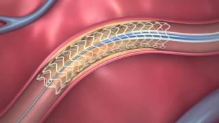 FDAApproved Dissolving Heart Stent  How It Works [upl. by Dennard]