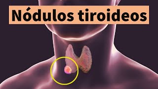 NÓDULOS TIROIDEOS síntomas diagnóstico tratamiento y prevención bulto o bola en el cuello [upl. by Oirazan]