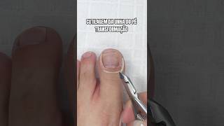 Transformação incrível da unha do pé 😍 pedicure manicure unhasdospés unhas pes [upl. by Alra26]