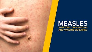 Measles  Symptoms Transmission and Treatment Explained By a Doctor [upl. by Nnairak]