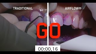 Dental treatment with the AIRFLOW® PERIOFLOW Method English [upl. by Htebilil]