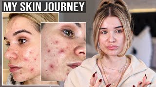 My Skin Story Going on ACCUTANE [upl. by Ecydnac]