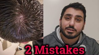 Hair Loss Mistakes  My Hair Journey  FAILED [upl. by Anika]