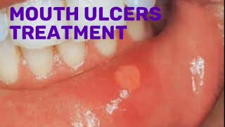 Drugs for mouth ulcers treatment pharmacist pharmacy [upl. by Sucramat]