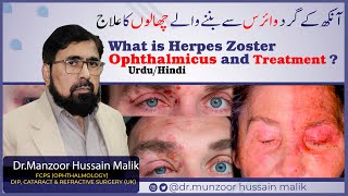 What is Herpes Zoster Ophthalmicus and Treatment   UrduHindi [upl. by Alahs]