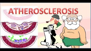 Atherosclerosis Pathophysiology [upl. by Fiel]