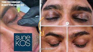 Dr Abs How To Get Rid Of Under Eye Dark Circles In 4 days WITHOUT Filler Skincare… [upl. by Higginbotham]