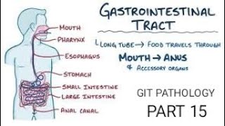 stomach  chronic gastritis autoimmune gastritis pathology git stomach [upl. by Nasas]