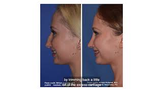 Rhinoplasty  Fixing a Hanging Columella  Do I have a Hanging Columella [upl. by Aleina]