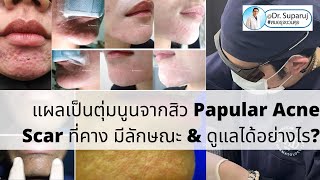 แผลเป็นตุ่มนูนจากสิว Papular Acne Scar ที่คาง มีลักษณะ amp ดูแลได้อย่างไร [upl. by Paapanen872]