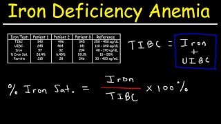 Iron Deficiency Anemia  TIBC UIBC Iron Saturation Transferrin amp Ferritin [upl. by Dnomde]